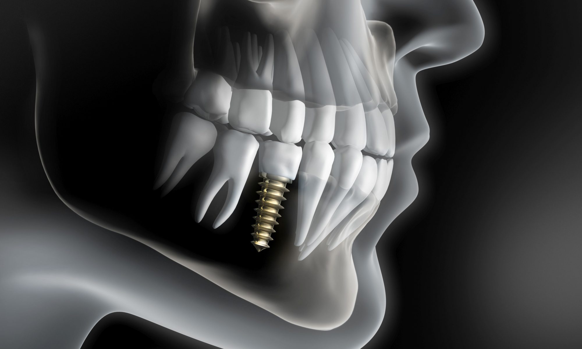 Implantat Regio 45